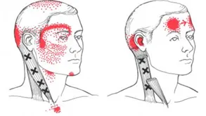 PGM músculo esternocleidomastoideo